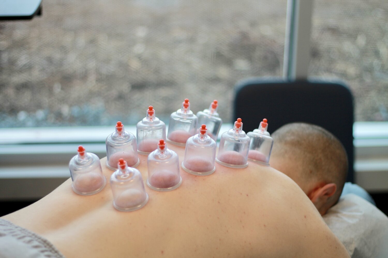 Cupping Therapy Treatment